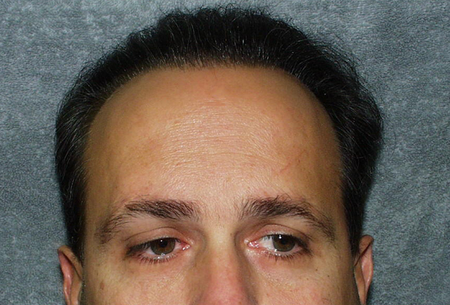 Pistone Hair Restoration