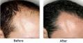 Chandigarh Hair Transplantation