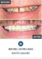 Goodbye Dentures