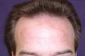 Robotic Hair Transplants Cincinnati