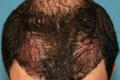 Affordable Hair Transplants Minneapolis