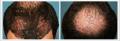 Robotic Hair Transplants Los Angeles