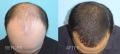 The Hair Restoration Experts