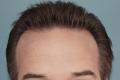 Robotic Hair Transplants Minneapolis