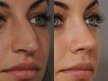 Rhinoplasty UK