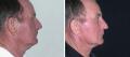 Dr Michael Zacharia - Facelift Sydney