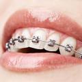 OrthodonTEX
