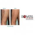 Bowers Vein Institute