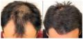 Virginia Hair Transplant
