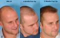 Best hair transplant Los Angeles - Revive hair restoration