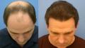Revive Hair Transplant Miami