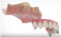 All On Four Dental Implants of Long Island