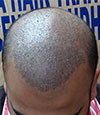 Hair Transplant India Ludhiana Punjab 