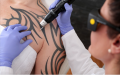 Tattoo Removal SG