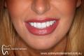 Sydney Dental Veneers