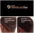 Hair Transplant Scar Clinic