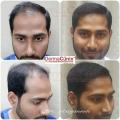 DermaClinix - Hair Transplant in Chennai 