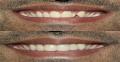 Dental Veneers & Lumineers
