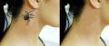 Best Laser Tattoo Removal in Melbourne - City of Ink