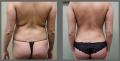 Chicago Liposuction by Lift Body Center