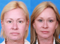 Campbell Facial Plastic Surgery