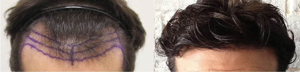 Rahal Hair Transplant Toronto
